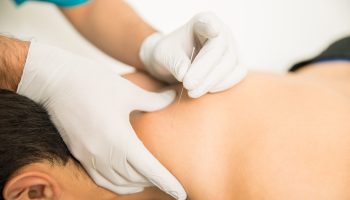 Closeup of shirtless man receiving dry needling therapy from doctor in clinic